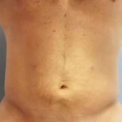 Smartlipo Vaser Lipo Before & After Patient #556