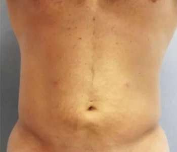 Smartlipo Vaser Lipo Before & After Patient #556