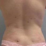Smartlipo Vaser Lipo Before & After Patient #561