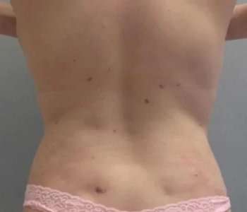 Smartlipo Vaser Lipo Before & After Patient #561