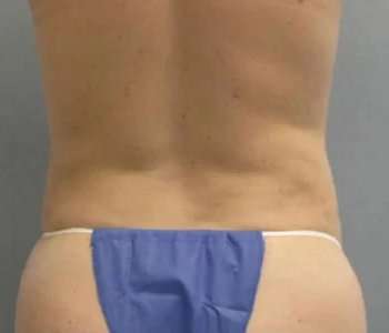Smartlipo Vaser Lipo Before & After Patient #567