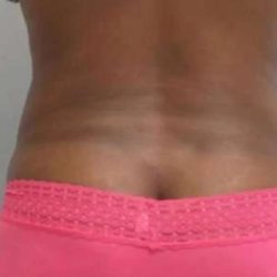 Smartlipo Vaser Lipo Before & After Patient #570
