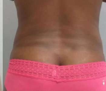 Smartlipo Vaser Lipo Before & After Patient #570