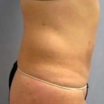 Smartlipo Vaser Lipo Before & After Patient #573