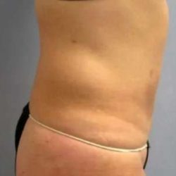Smartlipo Vaser Lipo Before & After Patient #573