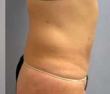 Smartlipo Vaser Lipo Before & After Patient #573