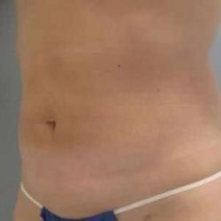 Smartlipo Vaser Lipo Before & After Patient #576