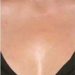Fractional CO2 Laser Before & After Patient #116