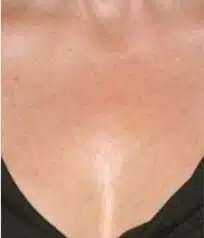 Fractional CO2 Laser Before & After Patient #116