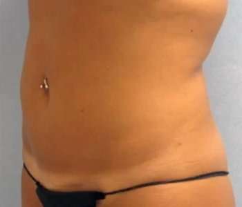 Smartlipo Vaser Lipo Before & After Patient #579