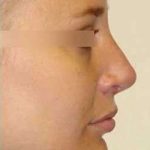 Rhinoplasty Before & After Patient #69