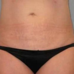 Smartlipo Vaser Lipo Before & After Patient #582