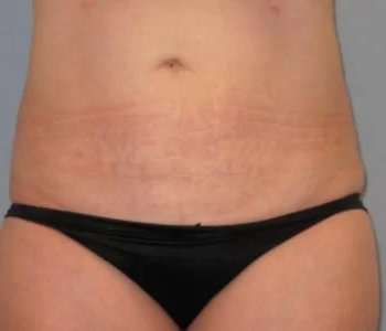 Smartlipo Vaser Lipo Before & After Patient #582