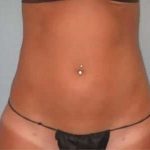 Smartlipo Vaser Lipo Before & After Patient #587