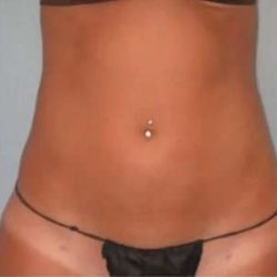 Smartlipo Vaser Lipo Before & After Patient #587