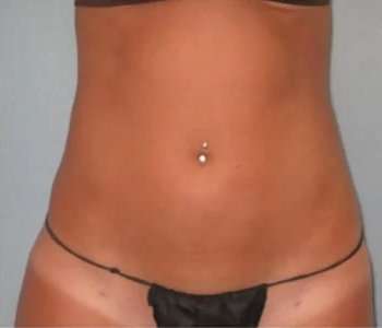 Smartlipo Vaser Lipo Before & After Patient #587