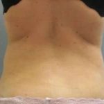 Smartlipo Vaser Lipo Before & After Patient #590