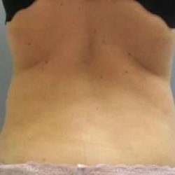 Smartlipo Vaser Lipo Before & After Patient #590
