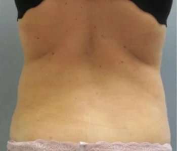 Smartlipo Vaser Lipo Before & After Patient #590