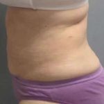 Smartlipo Vaser Lipo Before & After Patient #593