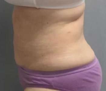 Smartlipo Vaser Lipo Before & After Patient #593