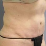 Smartlipo Vaser Lipo Before & After Patient #596