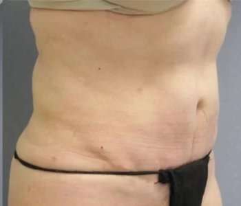 Smartlipo Vaser Lipo Before & After Patient #596
