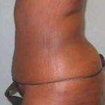 Smartlipo Vaser Lipo Before & After Patient #599