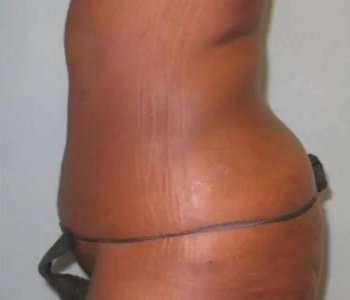 Smartlipo Vaser Lipo Before & After Patient #599