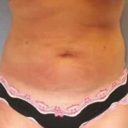 Smartlipo Vaser Lipo Before & After Patient #602