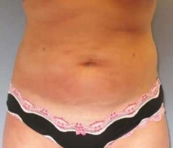 Smartlipo Vaser Lipo Before & After Patient #602