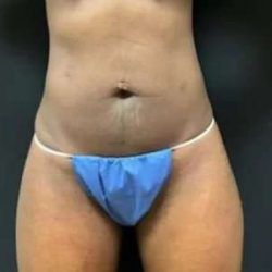 Smartlipo Vaser Lipo Before & After Patient #605