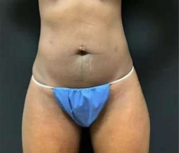Smartlipo Vaser Lipo Before & After Patient #605