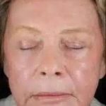 Fractional CO2 Laser Before & After Patient #119