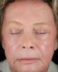 Fractional CO2 Laser Before & After Patient #119