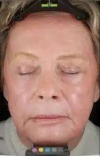 Fractional CO2 Laser Before & After Patient #119