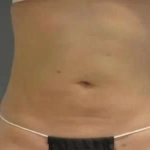 Smartlipo Vaser Lipo Before & After Patient #611