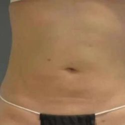 Smartlipo Vaser Lipo Before & After Patient #611
