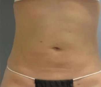 Smartlipo Vaser Lipo Before & After Patient #611