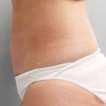 Smartlipo Vaser Lipo Before & After Patient #614