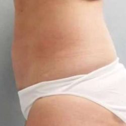 Smartlipo Vaser Lipo Before & After Patient #614