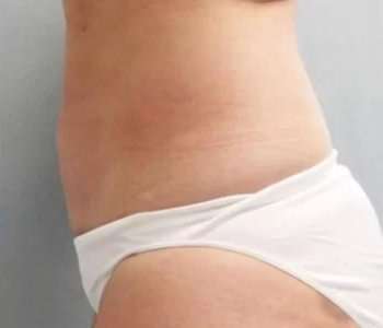 Smartlipo Vaser Lipo Before & After Patient #614