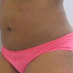 Smartlipo Vaser Lipo Before & After Patient #617