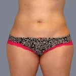 Smartlipo Vaser Lipo Before & After Patient #624