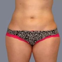 Smartlipo Vaser Lipo Before & After Patient #624