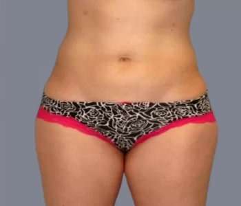 Smartlipo Vaser Lipo Before & After Patient #624
