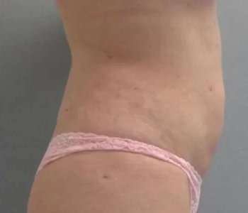 Smartlipo Vaser Lipo Before & After Patient #630
