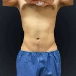 Smartlipo Vaser Lipo Before & After Patient #633