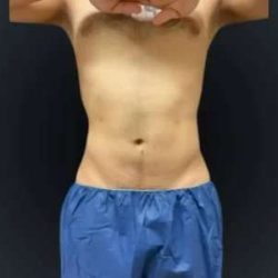 Smartlipo Vaser Lipo Before & After Patient #633