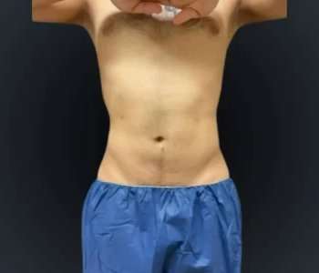Smartlipo Vaser Lipo Before & After Patient #633